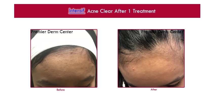acne-radioendymed- ,Premier Derm Center PLLC | Houston, TX